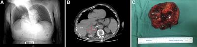 Case Report: Surgery to remove adrenocortical oncocytic carcinoma from an Asian male